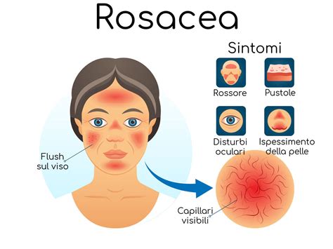 Immagine che mostra le diverse manifestazioni della rosacea sul viso (eritema, teleangectasie, papule, pustole, rinofima)