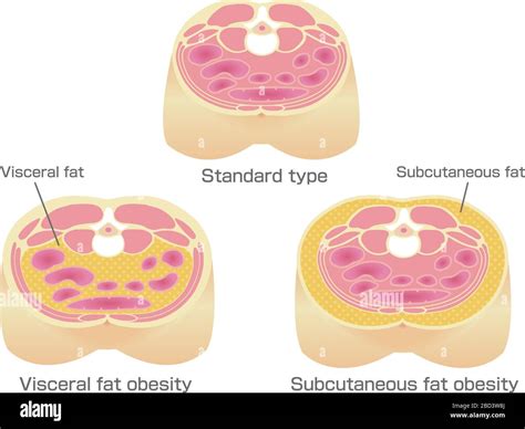 Illustrazione che mostra la differenza tra grasso sottocutaneo e grasso viscerale attorno agli organi addominali.