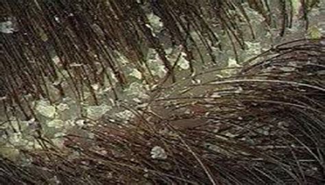 Immagine comparativa: da un lato scaglie di forfora che cadono liberamente, dall'altro lendini aderenti ai capelli vicino al cuoio capelluto.