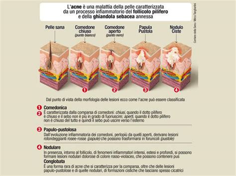 illustrazione delle diverse tipologie di lesioni acneiche: comedone, papula, pustola, nodulo, cisti