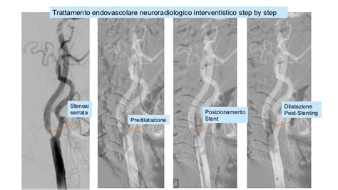 Schema comparativo tra endoarteriectomia carotidea e stenting carotideo.
