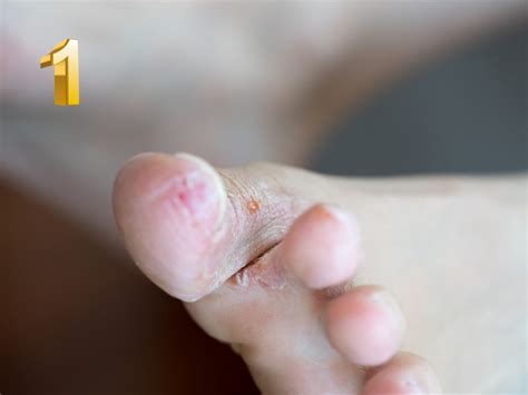 Infografica che illustra i luoghi comuni dove si contraggono infezioni fungine (piscine, palestre, ecc.)