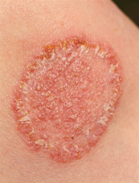 Immagini comparative che mostrano i diversi tipi di micosi cutanee (piede d'atleta, tinea versicolor, tigna, ecc.)