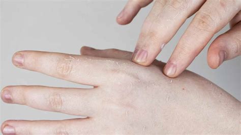 Infografica con consigli pratici per la prevenzione delle micosi cutanee