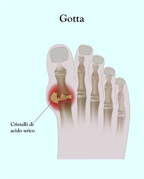 illustrazione di un alluce colpito dalla gotta, con rossore e gonfiore