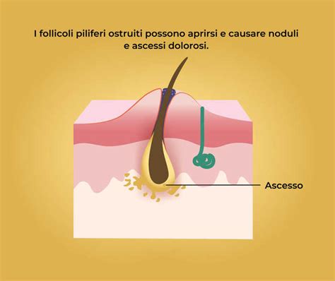 Illustrazione di un ascesso maturo e di un parto maturo
