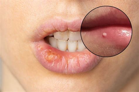 Immagine microscopica di gamberetti affetti dalla malattia dei puntini bianchi, evidenziando le macchie.