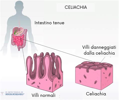 Schema che illustra come la celiachia compromette l'assorbimento di calcio e vitamina D, portando all'osteoporosi.