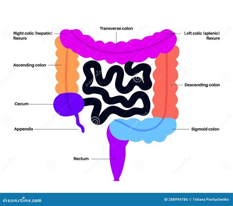 Illustrazione dell'intestino tenue umano con evidenziate le aree colpite dalla celiachia