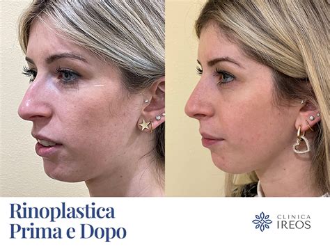 Dina Manzo prima e dopo l'intervento al naso