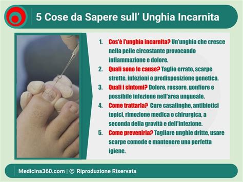 Immagine ravvicinata di un'unghia del piede affetta da micosi, mostrando ingiallimento, ispessimento e sfaldamento.